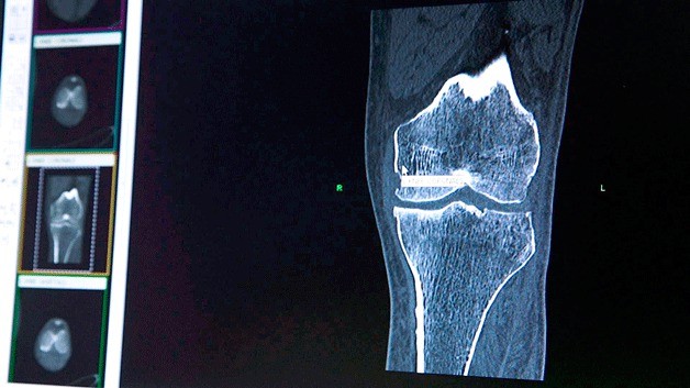 A CT-scan of a knee