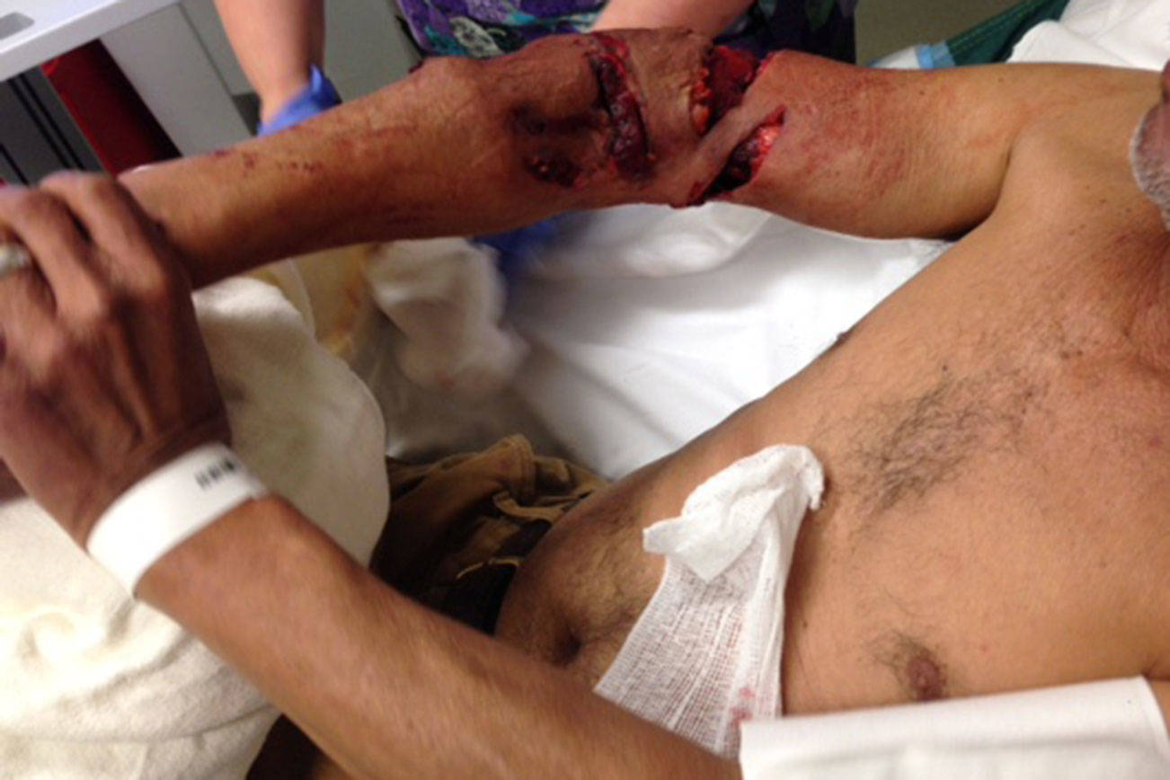 An image of Urbano Velazquez’s arm after he was bitten by a King County Sheriff’s Office K-9. It has been cropped to remove Velazquez’s face. Photo obtained through a records request from King County Sheriff’s Office.