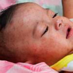 Infant with measles. Photo courtesy of Washington State Department of Health/Centers for Disease Control
