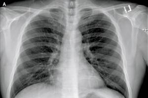Posteroanterior and Lateral Chest Radiographs, January 19, 2020 (Illness Day 4).No thoracic abnormalities were noted (Snohomish Health District)