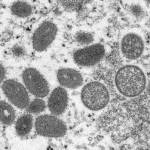 Monkeypox virus. Photo courtesy of the Centers for Disease Control.